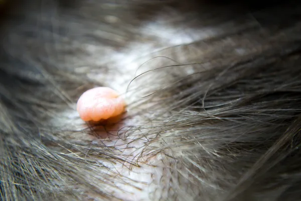 Вирусная папиллома на голове среди волос. — стоковое фото