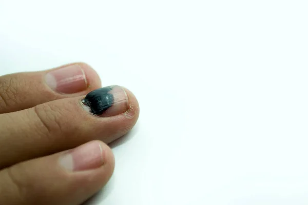 A bruise on the finger nail. Concept of a safety violation — Stock Photo, Image