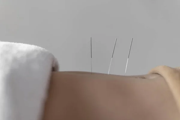 Sluit de acupunctuurprocedure af. Hoge kwaliteit mooi foto concept — Stockfoto