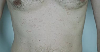 Pityriasis versicolor on the male body. The hand scratches the chest, skin disease, red spots. Demonstration of symptoms. High quality 4k footage