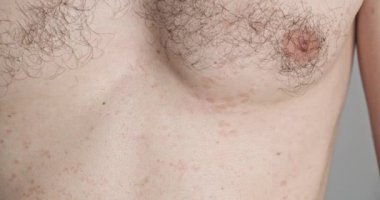 Pityriasis versicolor, skin disease, fungus on the body. Rash on the male chest, dermatology, red spots on the skin. High quality 4k footage