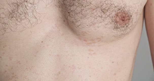 Pityriasis Versicolor Skin Disease Fungus Body Rash Male Chest Dermatology — Stok video