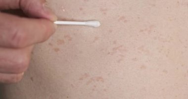 Caucasian man smears red spots on his skin with a cotton swab. Pityriasis versicolor, rubbing ointment, self-medication, skin disease, front view, close-up. High quality 4k footage