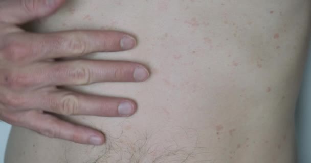 Male Chest Lichen Disease Pink Pityriasis Skin Disease Small Red — Vídeo de Stock