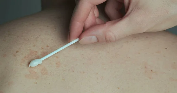 Doctor lubricates the red spots on the back of the patient with an ointment with a cotton swab. Treatment of skin disease, pityriasis versicolor, close-up. High quality photo