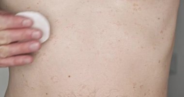 Treatment of skin disease, ringworm. Cotton pad, smear the body. A man treats himself with an ointment, close-up, front view, chest. High quality 4k footage