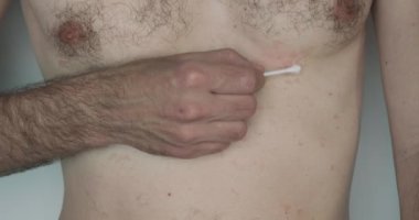 Patient with a skin disease smears red spots on the skin with a white ointment. Close-up, front view, chest. Dermatology, medicine, health. High quality 4k footage