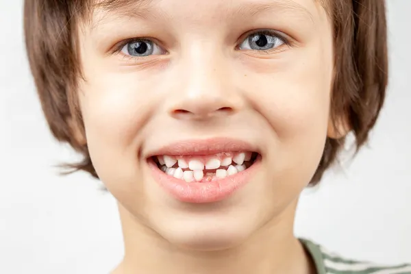 没有一颗门牙的白人男孩 牙齿健康概念 — 图库照片