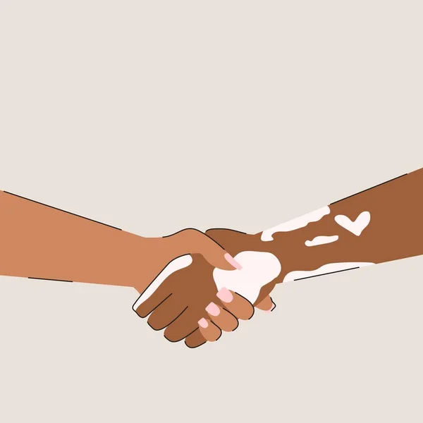 Vitiligo deri hastalığı olan bir adamın elleri. Destek, sevgi ve yardım. Dünya Vitiligo Günü. Düz vektör çizimi izole edildi
