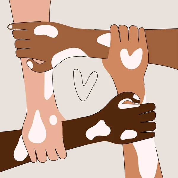Vitiligo depigmantasyonu olan açık tenli eller kalp şeklinde bir sembol oluşturuyor. Vitiligo farkındalığı, vücut pozitifliği, kendini sevme. Vektör.