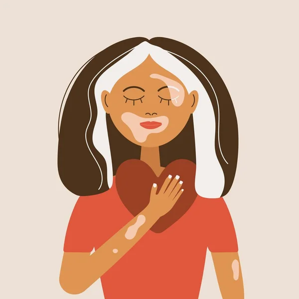 Vitiligo depigmantasyonu olan açık tenli eller kalp şeklinde bir sembol oluşturuyor. Vitiligo farkındalığı, vücut pozitifliği, kendini sevme. Vektör.