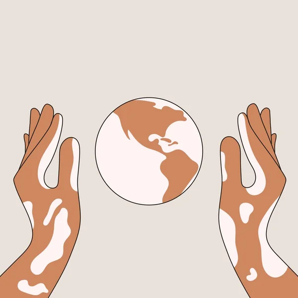 Vitiligo cilt hastalığı olan insanları desteklemek için.