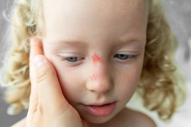 Close-up of the face of a sad child with a scratch on his nose. Injury after a fall.