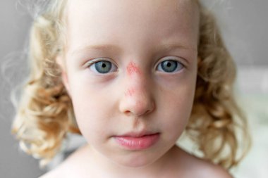 Close-up of the face of a sad child with a scratch on his nose. Injury after a fall.
