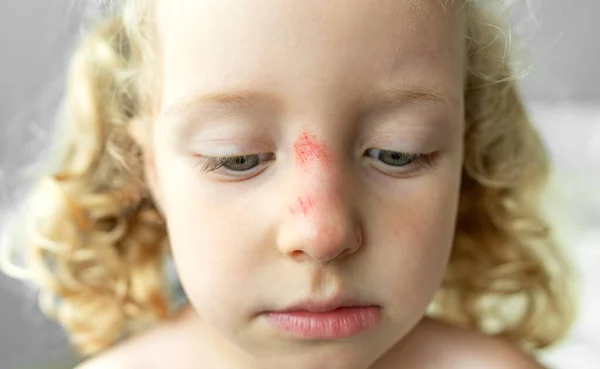 Close-up of the face of a sad child with a scratch on his nose. Injury after a fall.