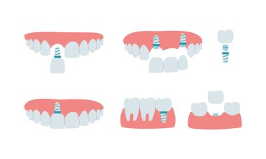 Sağlıklı dişleri, diş implantı ve diş köprüsü olan bir çene. Kurulum süreci ve bir azı dişi implantı şeması, bir kesici diş. Düz biçimde izole edilmiş vektör çizimleri kümesi
