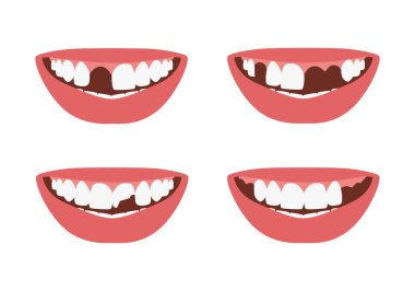Woman's mouth with missing, broken teeth. Lost incisor, molars. Dental problems isolated set. Vector illustration clipart