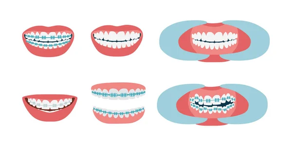 Diş tellerini düzeltiyorum. Ortodontik tedavi aşamaları. Ağzında yamuk dişler, parantezli ve düz. Sağlıklı bir gülümseme. İzole edilmiş düz vektör çizimi.