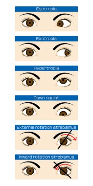Strabismus türlerini gösteren materyal
