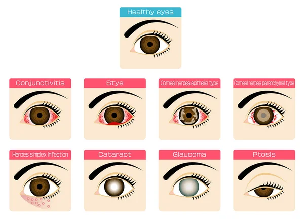 Material Ilustrado Para Enfermedades Oculares — Vector de stock