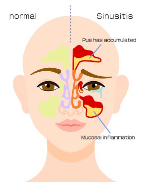 Material that illustrates the symptoms of sinusitis