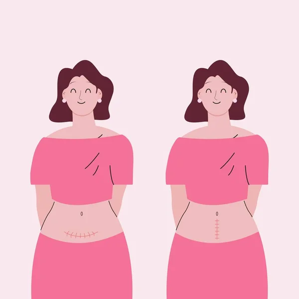 水平和垂直剖宫产的妇女 — 图库矢量图片