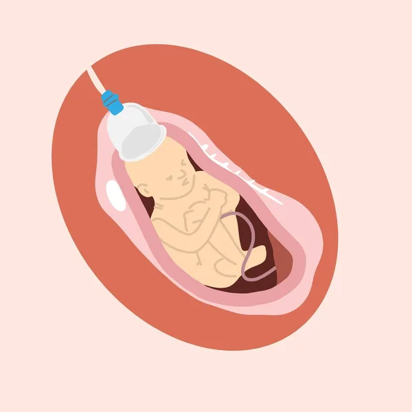 Birth Baby Vacuum Process Obgyn Medical Content — Stockový vektor