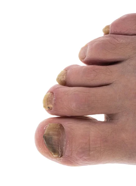 Sick Nail Leg Fungus Big Toe — Stock Photo, Image