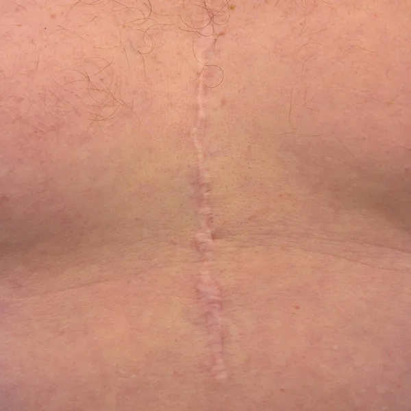 Scar from open heart surgery on white man, where the sternum was cut in two, and the rib cage sprung.