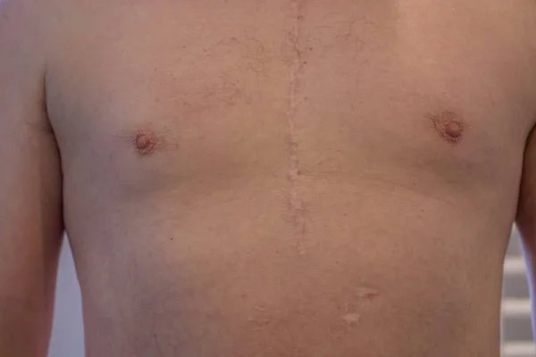 Scar from open heart surgery on white man, where the sternum was cut in two, and the rib cage sprung.
