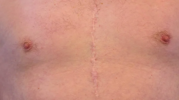 Göğüs kafesinin ikiye bölündüğü ve göğüs kafesinin açıldığı beyaz adamın açık kalp ameliyatından kalma yara..