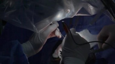 Beyin anevrizmasının tedavisi için. Beyin cerrahi müdahalesi. Bir grup cerrah tümörü almak için beyin ameliyatı yapıyor..