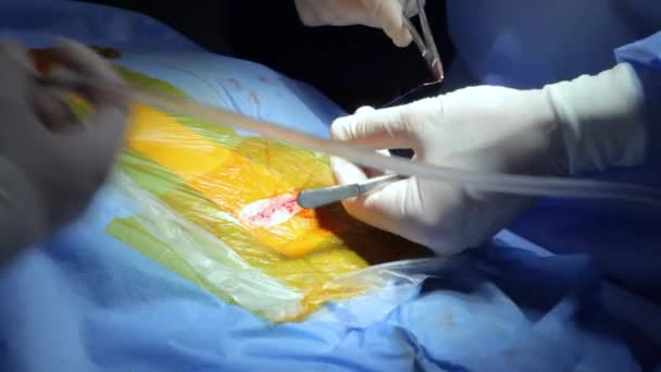 Neurocirujano Realiza Derivación Ventrículo Peritoneal Conductor Médico Derivación Cirugía Para — Vídeo de stock