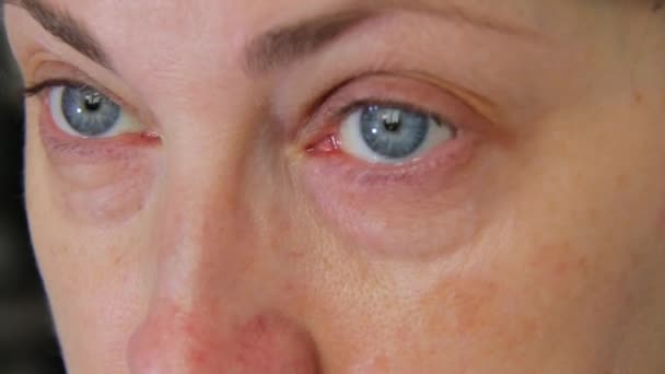 Μια Γυναίκα Βάζει Φακούς Επαφής Φακοί Επαφής Διόρθωση Όρασης Φακούς — Αρχείο Βίντεο