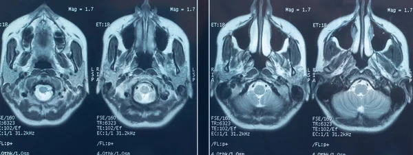 Foto Close Uma Ressonância Magnética Crânio Cérebro Uma Pessoa Com — Fotografia de Stock