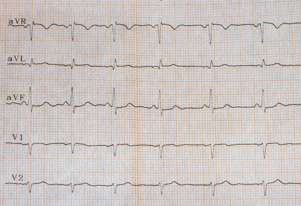 Foto Perto Eletrocardiograma Mostrando Aumento Frequência Cardíaca Arritmias Cardíacas Ultrassonografia — Fotografia de Stock