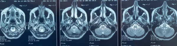 Foto Close Uma Ressonância Magnética Crânio Cérebro Uma Pessoa Com — Fotografia de Stock