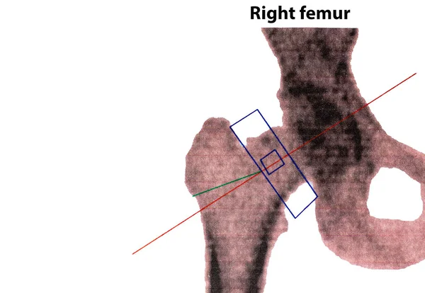 Close-up photo of the right femoral DEXA-osteodensimetry test, which measures bone density using X-rays, the imaging method used to diagnose osteoporosis; copy space