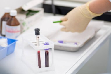 Eldivenli laboratuvar asistanı kan örneklerini kan tüpleriyle karşılaştırmaya hazırlanıyor.