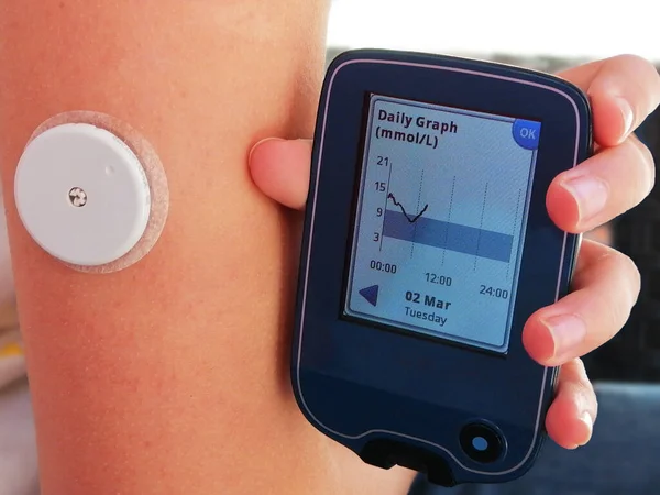 用连续血糖检测装置读取Cgm中的葡萄糖 在手臂上放置白色传感器 巫婆向Cgm设备发送信息 屏幕上的每日图表 — 图库照片