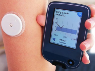 Kan CGM 'inde sürekli glikoz izleme cihazı kullanarak glikoz seviyesini okuma anı. Koldaki beyaz sensör cadısı CGM cihazına bilgi gönderiyor. Diyabet Tipi 1