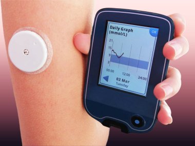 Kan CGM 'inde sürekli glikoz izleme cihazı kullanarak glikoz seviyesini okuma anı. Koldaki beyaz sensör cadısı CGM cihazına bilgi gönderiyor. Diyabet türü 1. Dünya Diyabet Günü, 14 Kasım