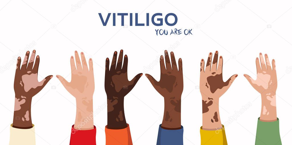 Hands of people with vitiligo are raised up and there is a place for text in the middle. Pigmentation on the hands. World Vitiligo Day concept. Banner design. Vector stock illustration. Vector