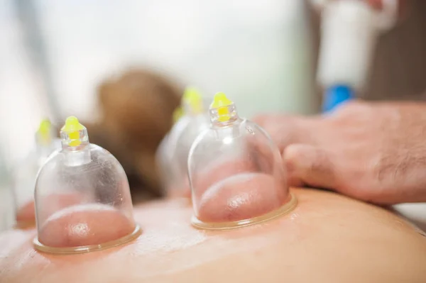 Glass vacuum cupping therapy on a woman\'s back, acupuncture treatment. Ventosa traditional massage. Alternative Medicine. Medical health care