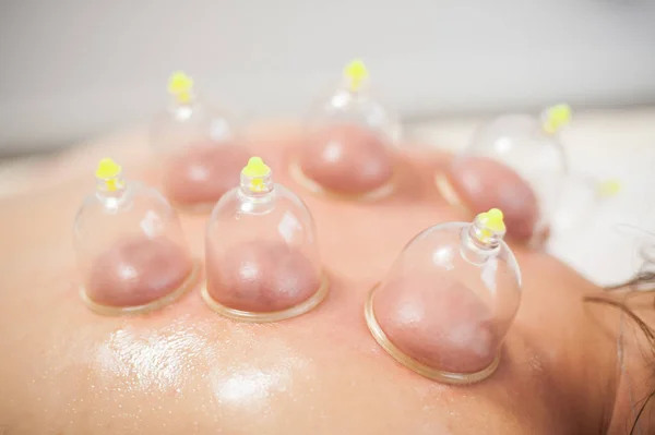 Glass Vacuum Cupping Therapy Woman Back Acupuncture Treatment Ventosa Traditional — Stock Fotó