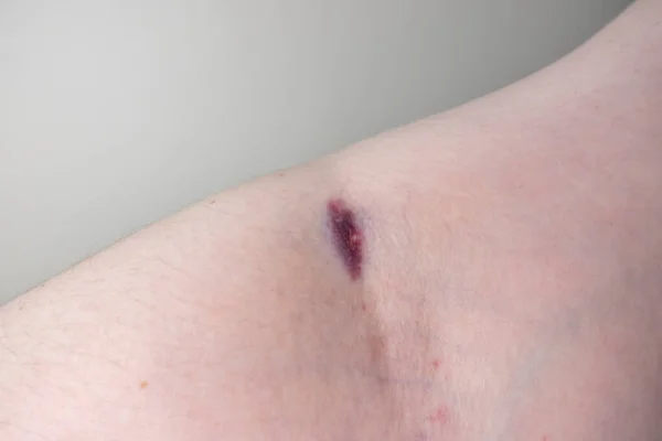 Close up view of a caucasian female\'s arm after having blood drawn