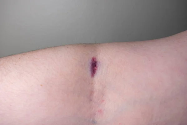 Close View Caucasian Female Arm Having Blood Drawn — Foto Stock