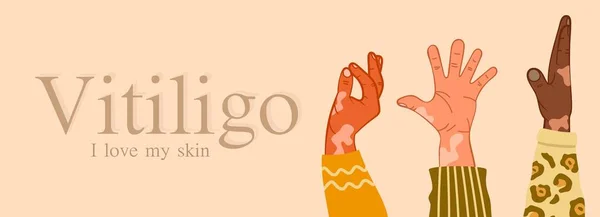 Vitiligo Tři Ruce Různých Ras Kožní Problémy Kožní Choroby Koncept — Stockový vektor