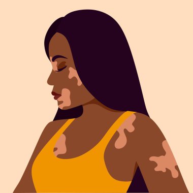 Vitiligo, cilt sorunları olan koyu tenli genç bir kadın. Deri hastalıkları. Dünya Vitiligo Günü konsepti. Kadın karakterlerin farklı ten renkleri. Bir blog, makaleler, afişler, dergiler için. 