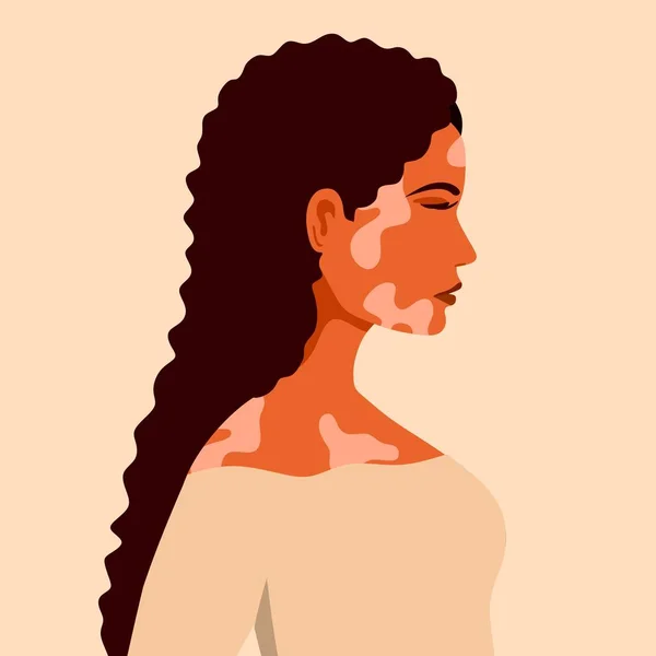 백반증은 피부에 문제가 여성이다 백반증의 World Vitiligo Day 캐릭터의 피부색 — 스톡 벡터